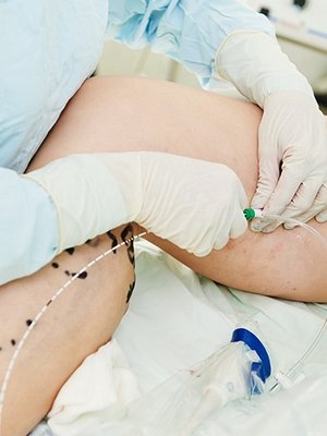 Varicose Vein Removal Surgery